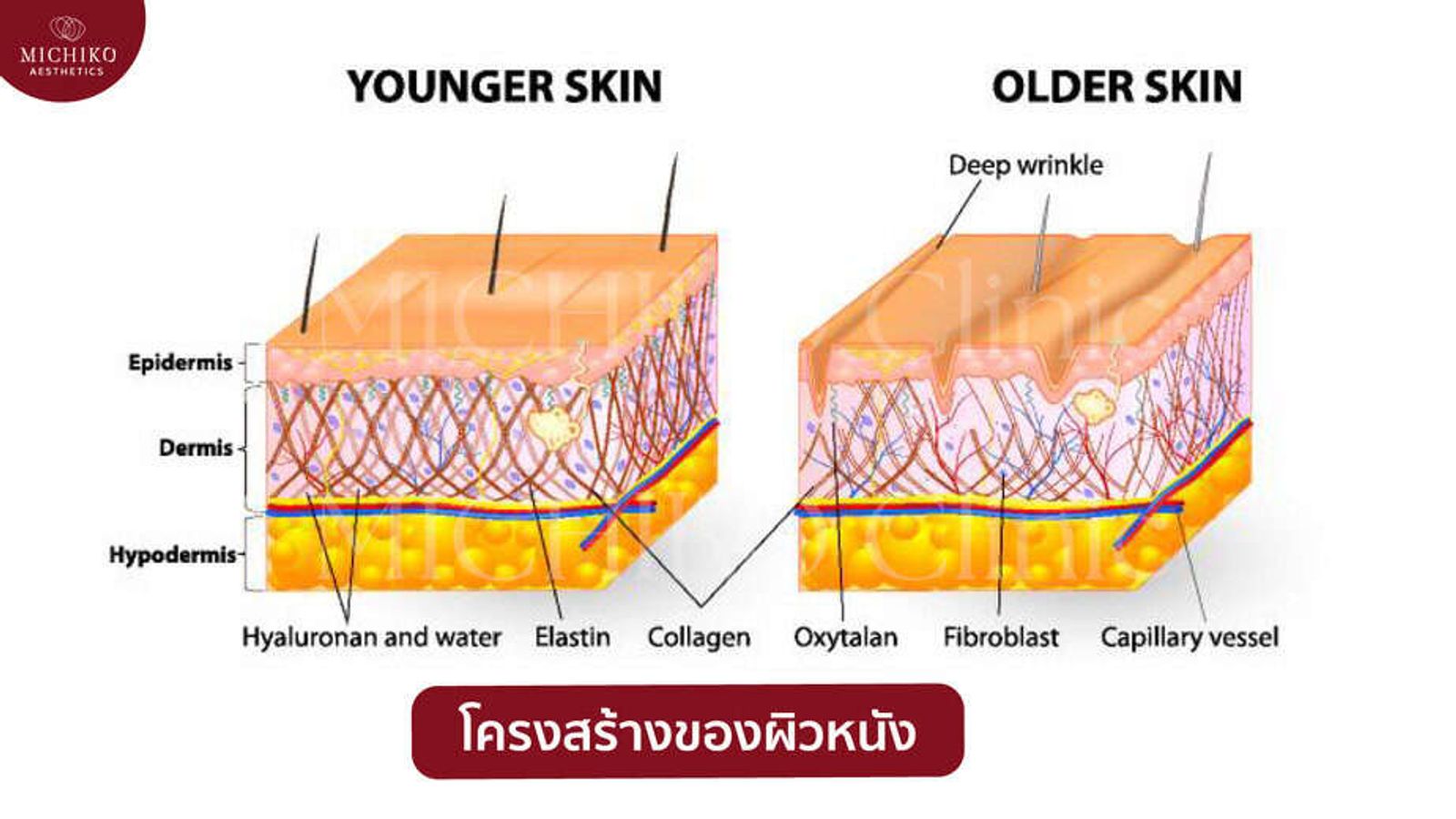 หน้าหย่อนคล้อย ไม่กระชับ เลือกทำหัตถการไหนดี? — ภาพประกอบ 02