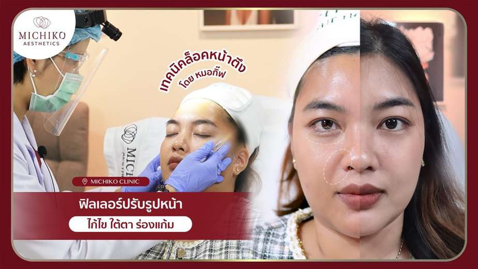[รีวิว] เติมเต็มใต้ตาและร่องแก้ม ฟิลเลอร์ Flore 2 cc เท่านั้น