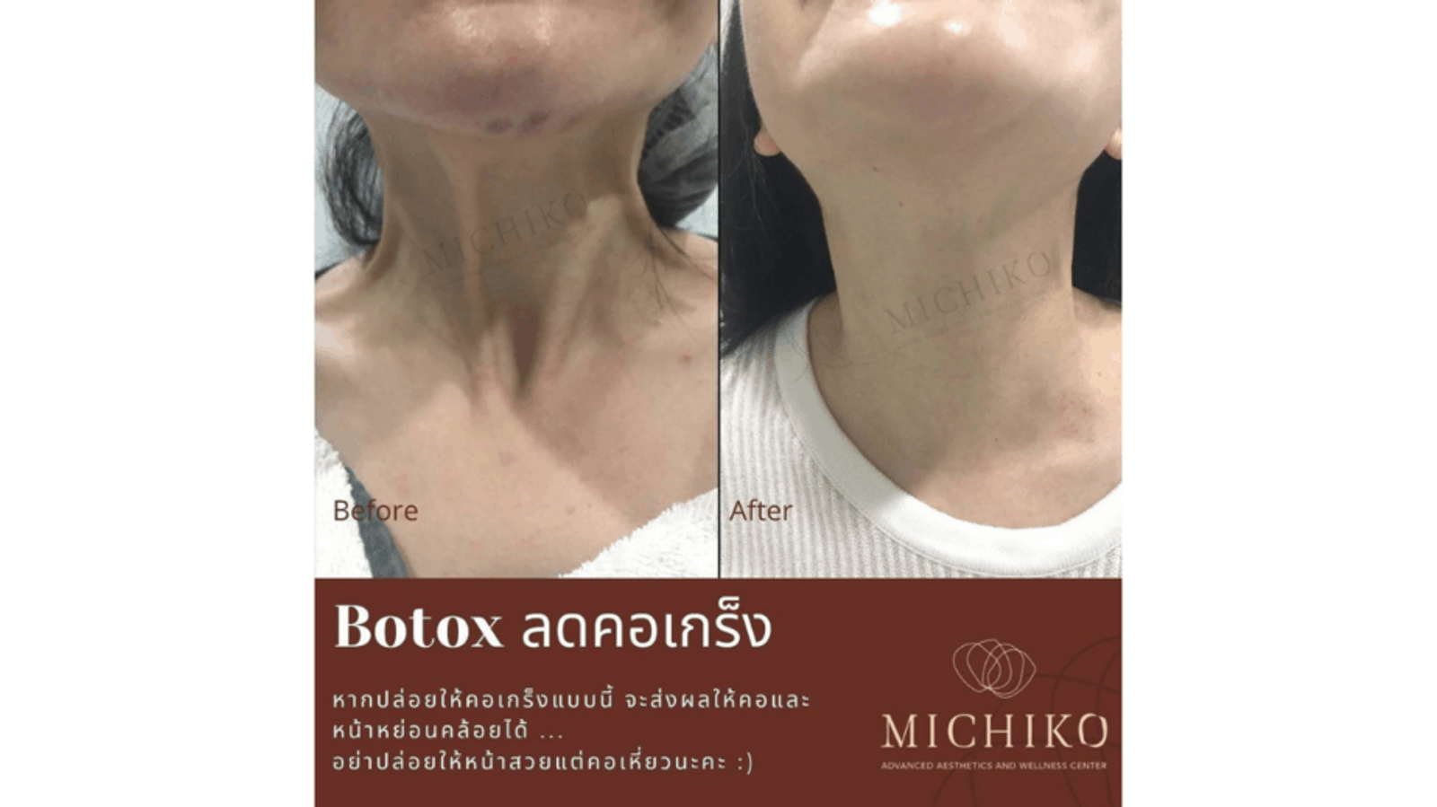 [รีวิว] Botox ลดคอเกร็ง
