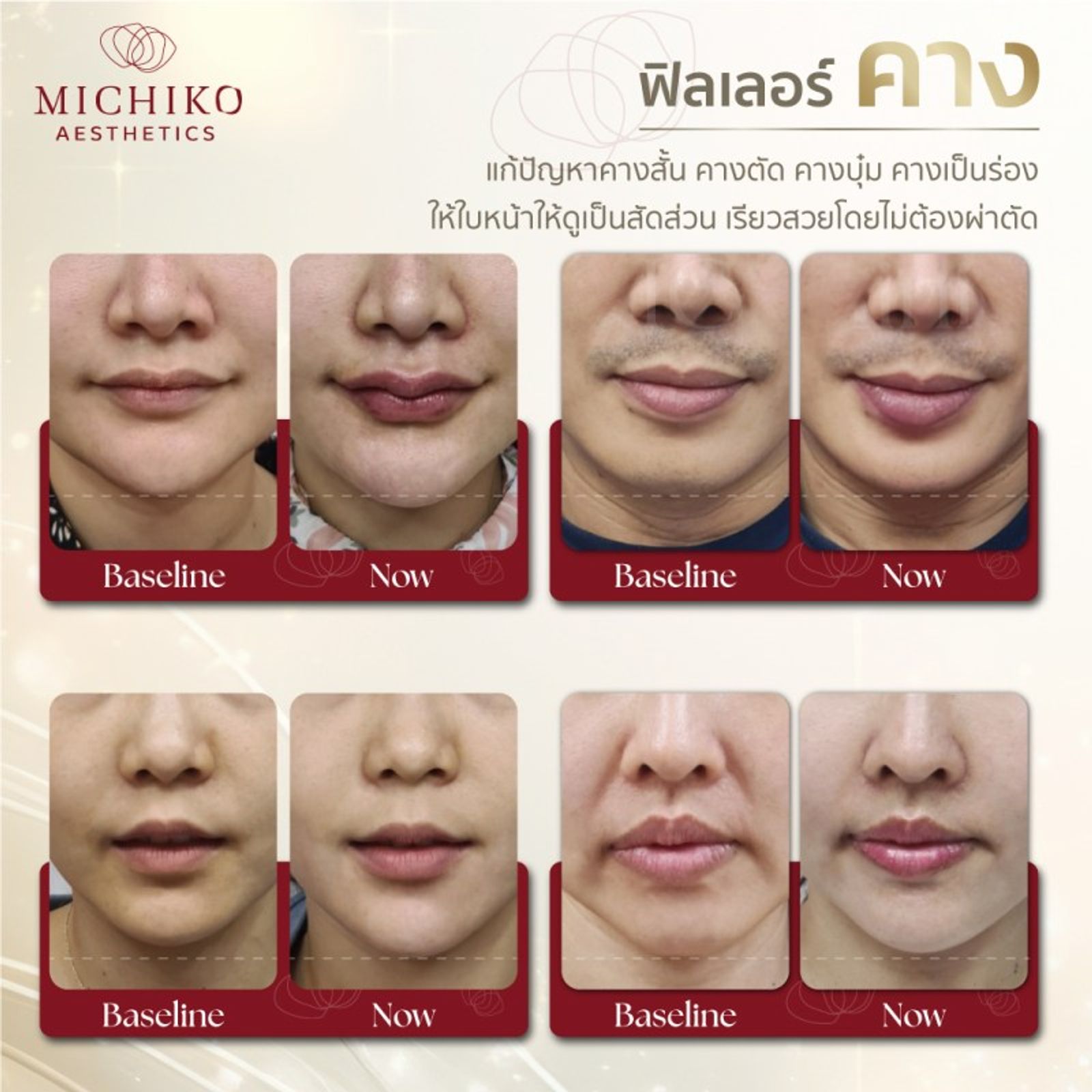 จุดฉีดฟิลเลอร์แล้วสวยแน่นอน !!! — ภาพประกอบ 02