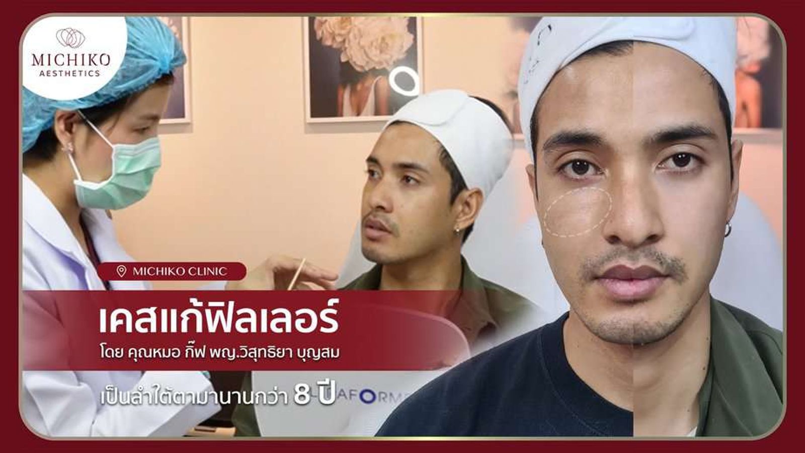 [รีวิว] ฟิลเลอร์ค้างอยู่ที่ใต้ตานานถึง 8 ปี