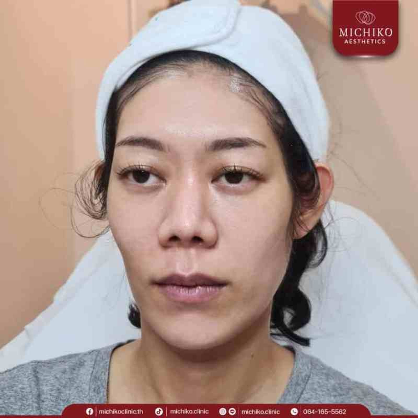 [รีวิว] หน้าตอบ ใต้ตาลึก ดูโทรม ฉีดฟิลเลอร์ใต้ตาที่มิชิโกะคลินิก ทำให้มั่นใจขึ้นเป็นกอง — ภาพประกอบ 04