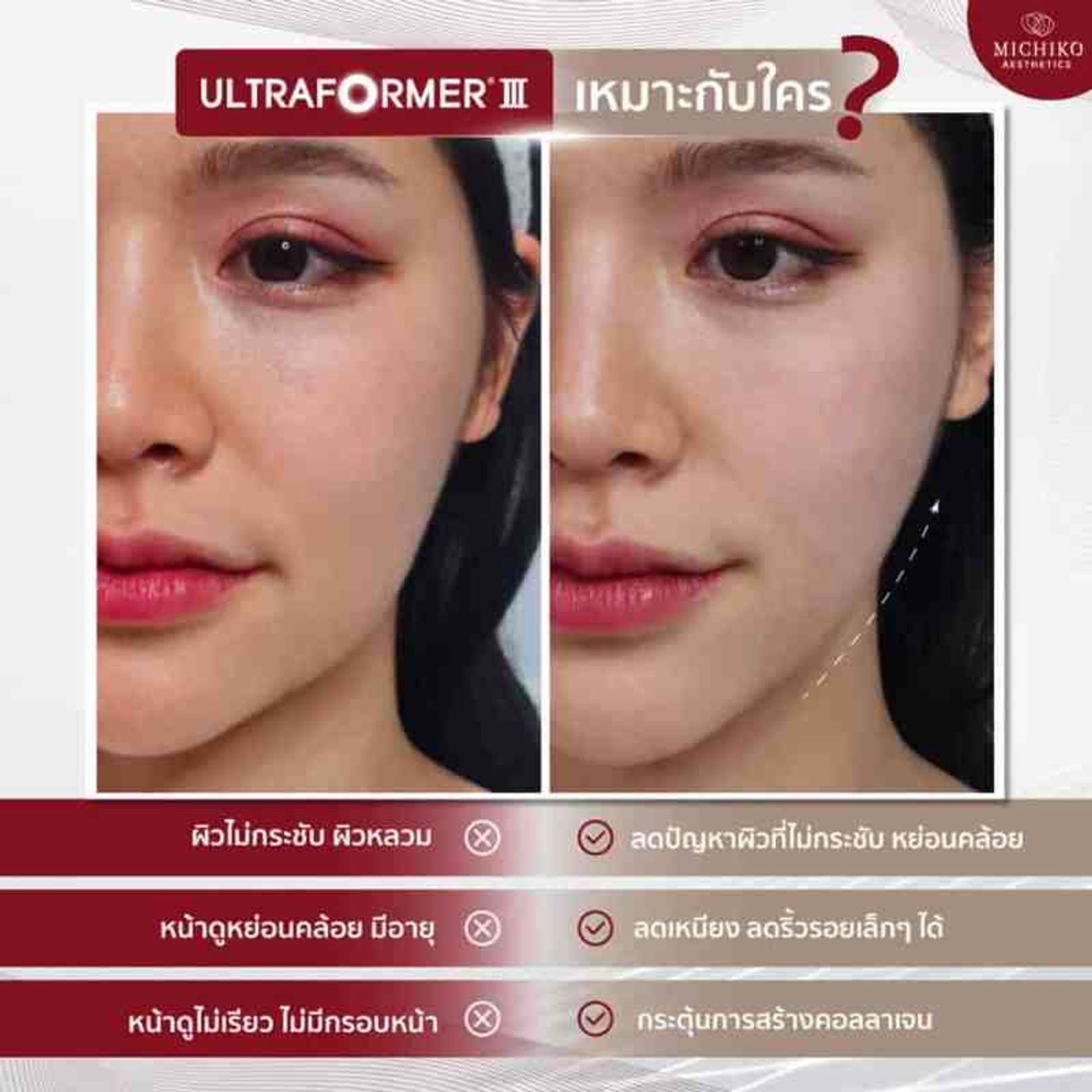 Ultraformer 𝐈𝐈𝐈 เทคโนโลยีช่วยกระชับผิวหน้า และสลายไขมันใต้ชั้นผิว กับเทคนิค #ล็อคหน้า SMAS Vector กับ #คุณหมอกิ๊ฟ ที่ MICHIKO Clinic — ภาพประกอบ 04
