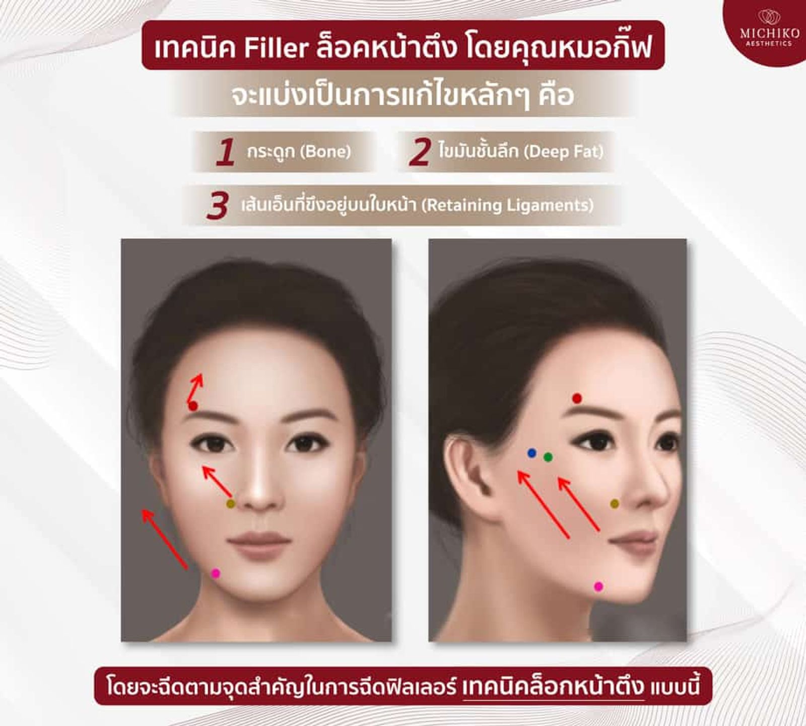 เทคนิค #ฟิลเลอร์ล็อคหน้าตึง คือการฉีดฟิลเลอร์แก้ไขโครงสร้าง ทำให้หน้ายกขึ้น อย่างเป็นธรรมชาติ — ภาพประกอบ 03