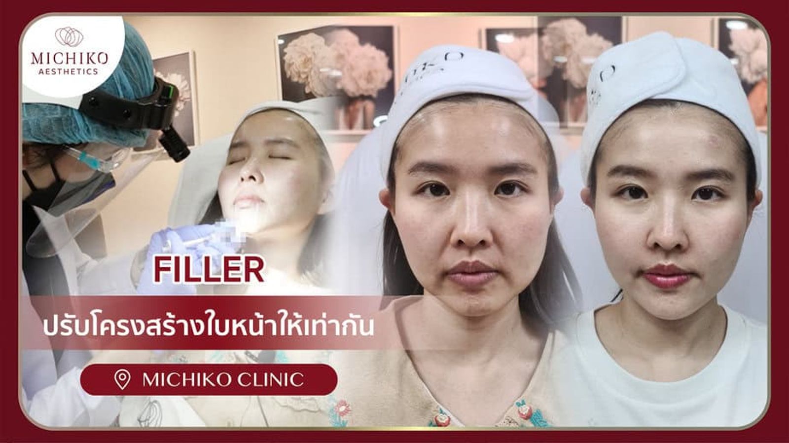 [รีวิว] หน้าไม่เท่ากัน หน้าตรงไม่สวย แก้โดยไม่ต้องพึ่งศัลยกรรม เทคนิคฟิลเลอร์โดยคุณหมอกิ๊ฟ