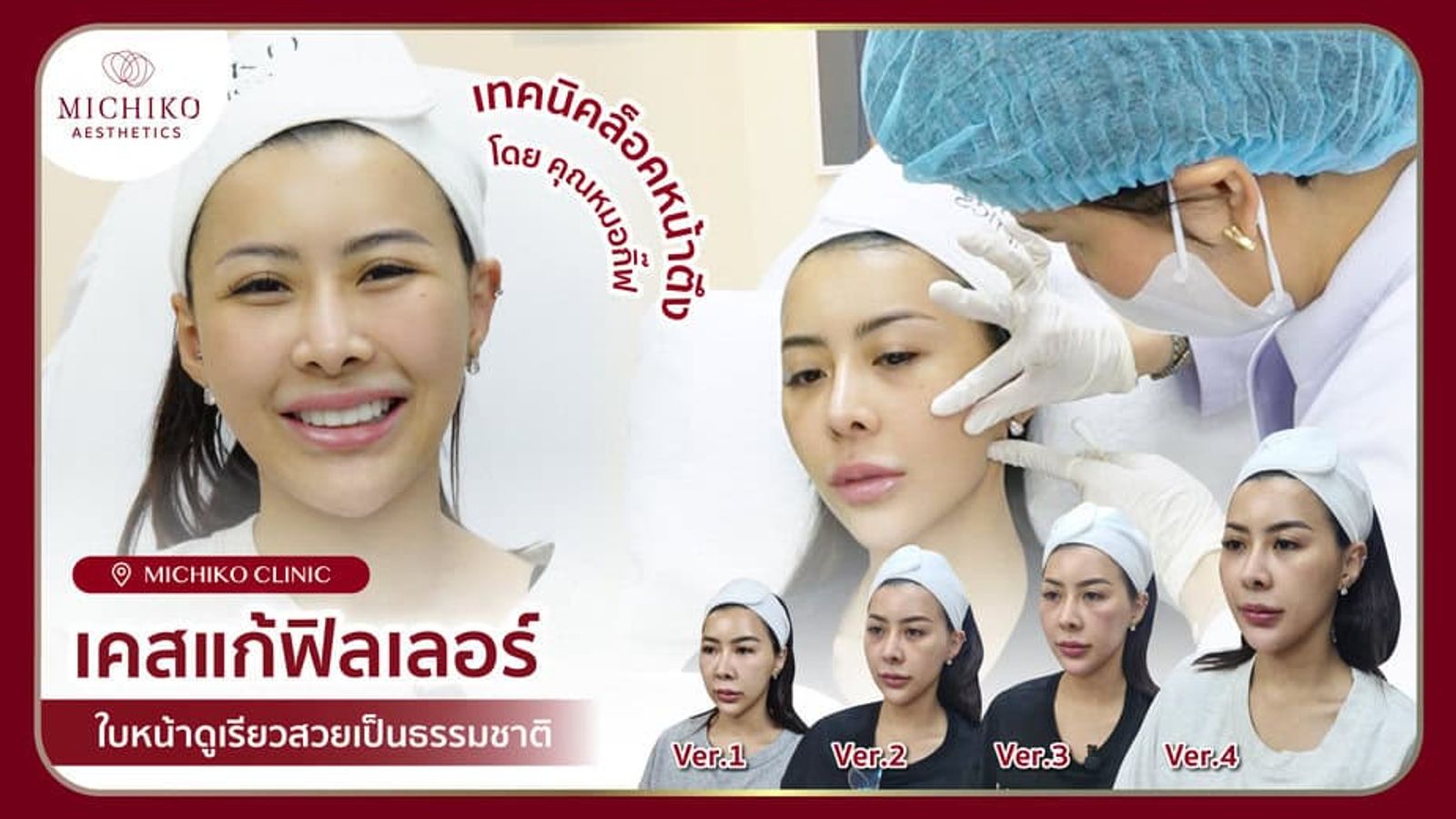 [รีวิว] หมอเดิมฉีดฟิลเลอร์ให้จนไม่สวย! ต้องหนีมาให้อาจารย์หมอกิ๊ฟสลายและแก้ให้ใหม่ทั้งหมด