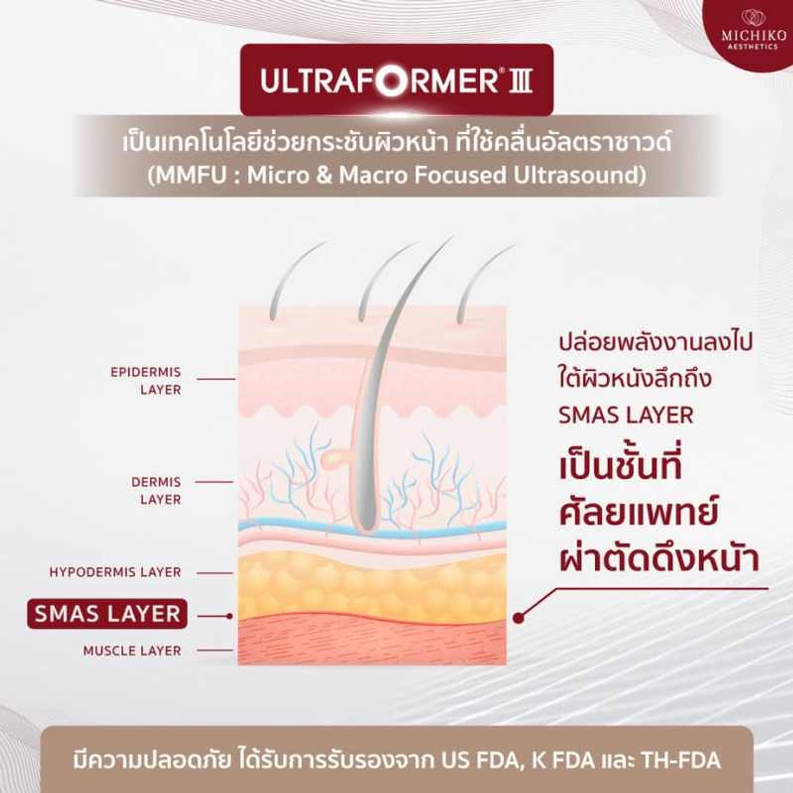 Ultraformer 𝐈𝐈𝐈 เทคโนโลยีช่วยกระชับผิวหน้า และสลายไขมันใต้ชั้นผิว กับเทคนิค #ล็อคหน้า SMAS Vector กับ #คุณหมอกิ๊ฟ ที่ MICHIKO Clinic — ภาพประกอบ 03