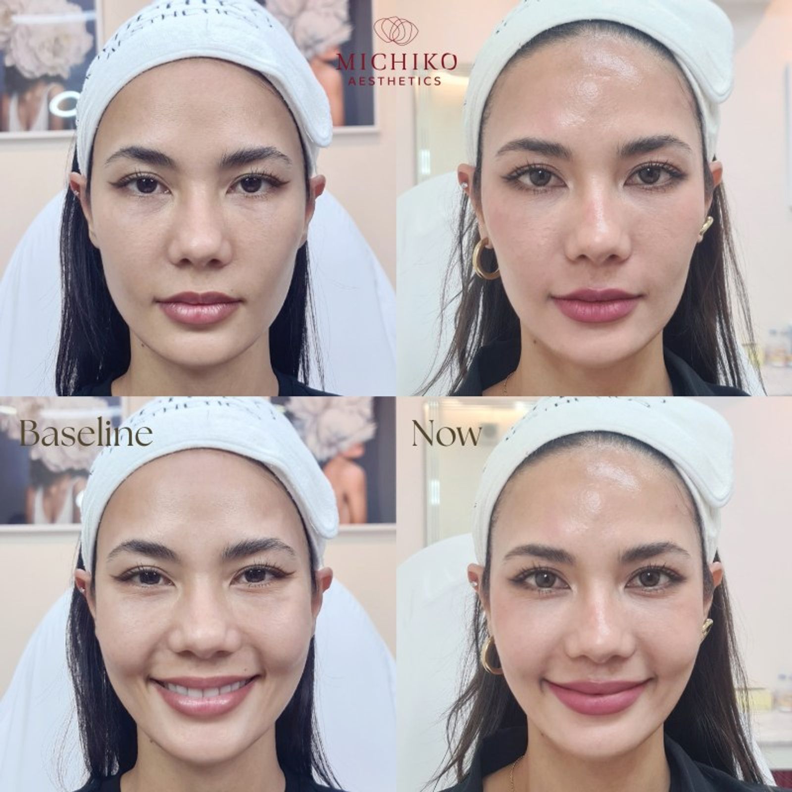 เคล็ดลับใหม่ของจักรวาล Sculptra ทำให้หน้าเด็กมากกก — ภาพประกอบ 03