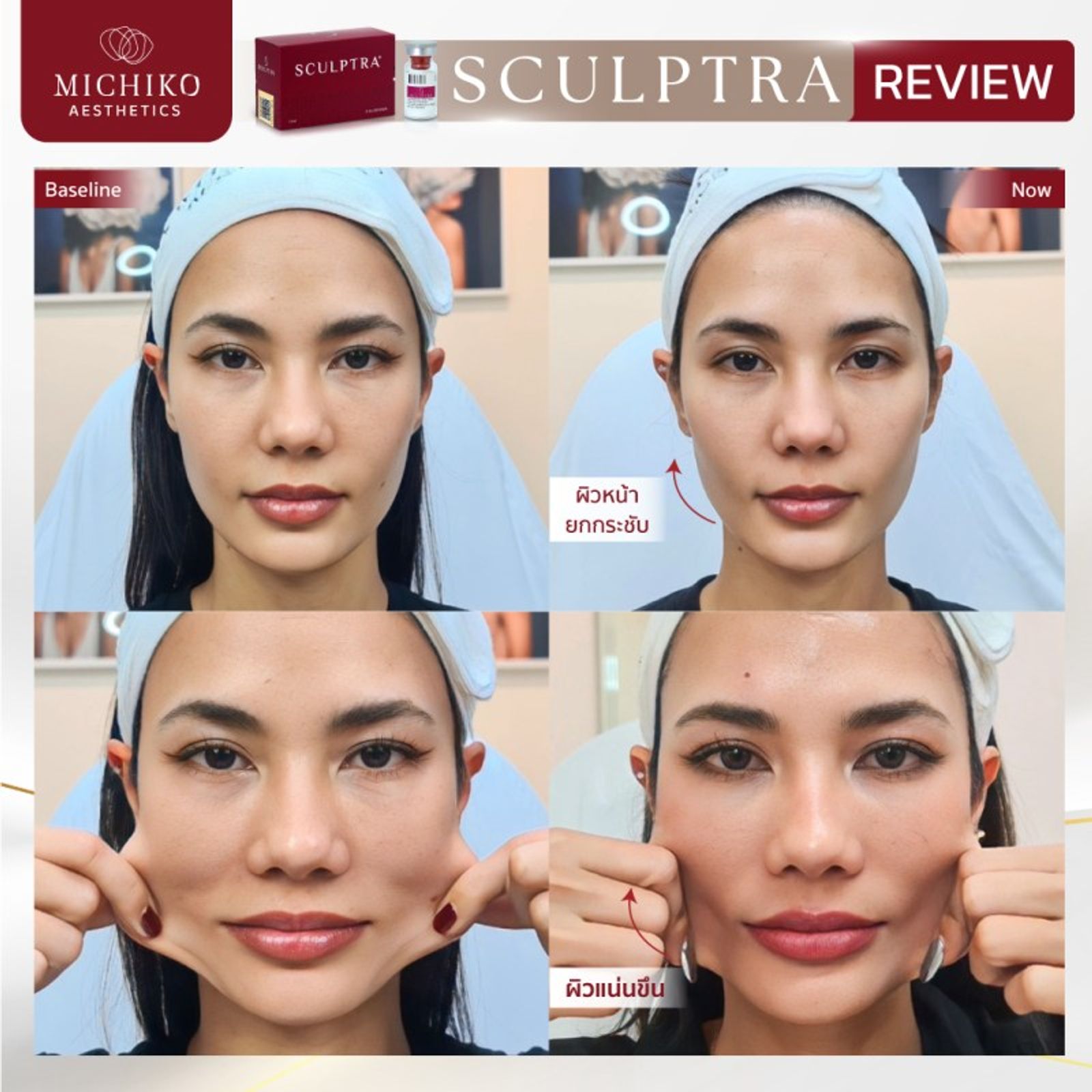 Sculptra คืออะไร ช่วยเรื่องอะไร — ภาพประกอบ 01