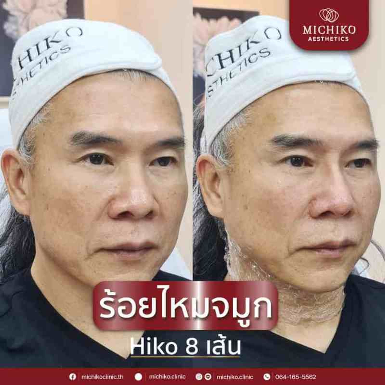 ร้อยไหมจมูกเหมาะกับใครบ้าง !!?? — ภาพประกอบ 01