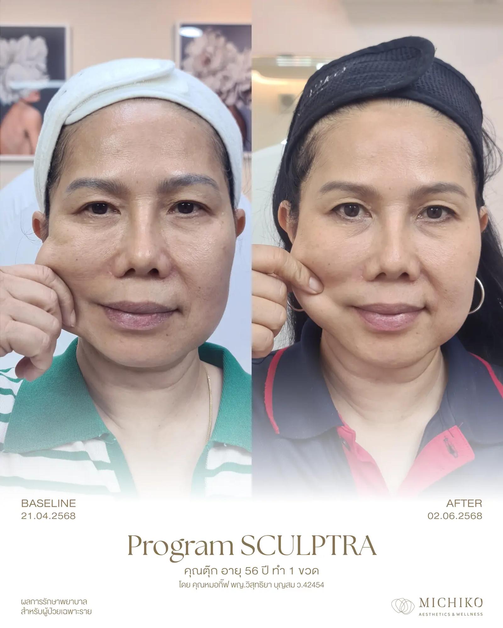 หนึ่งขวด กับการติดตามหกสัปดาห์ — ภาพเคส Sculptra ของ MICHIKO ผลลัพธ์เฉพาะบุคคล