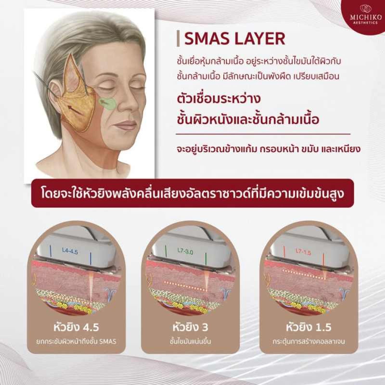 Ultraformer 𝐈𝐈𝐈 เทคโนโลยีช่วยกระชับผิวหน้า และสลายไขมันใต้ชั้นผิว กับเทคนิค #ล็อคหน้า SMAS Vector กับ #คุณหมอกิ๊ฟ ที่ MICHIKO Clinic — ภาพประกอบ 02