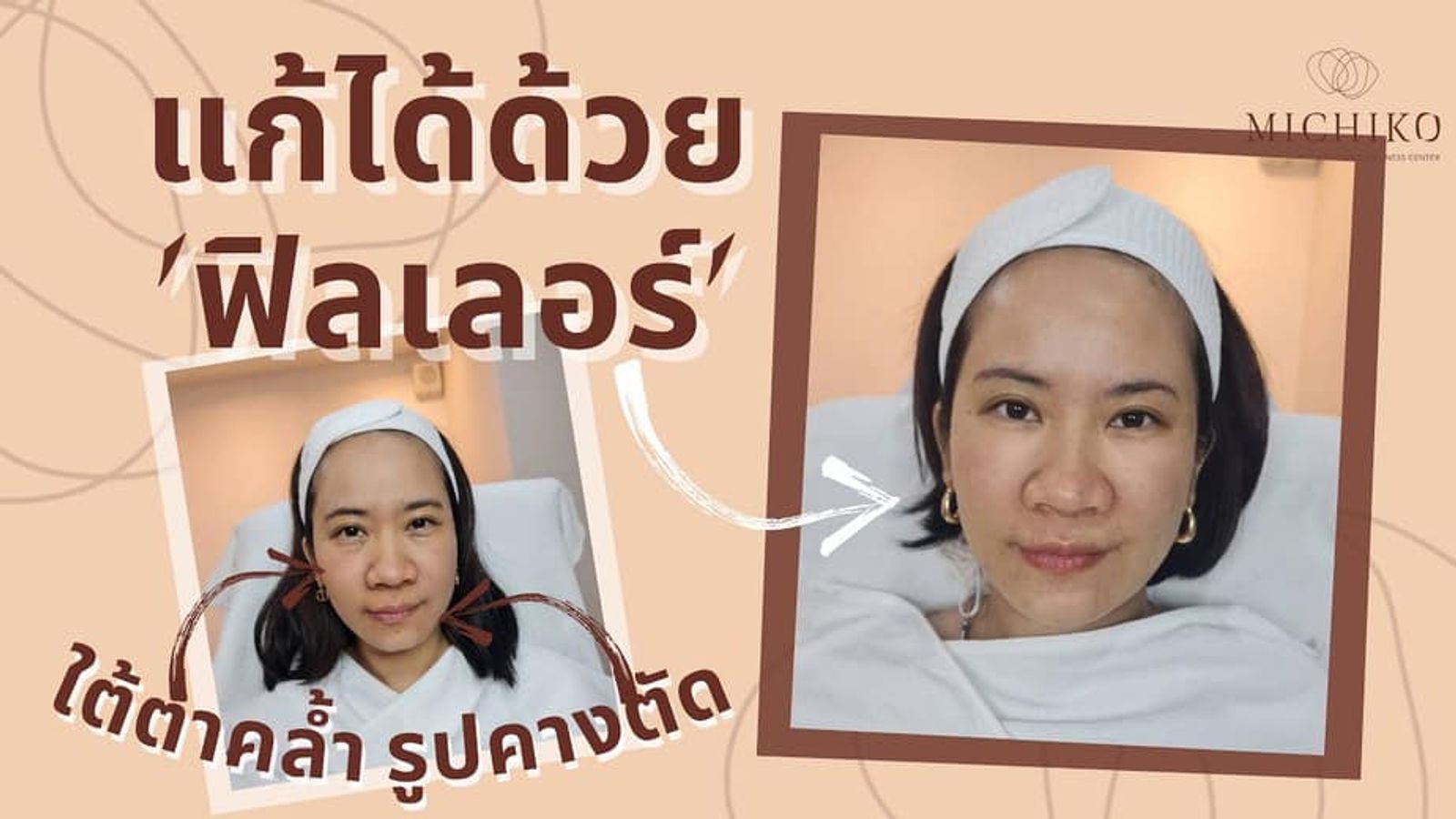 [รีวิว] ฟิลเลอร์ปรับรูปหน้า ใต้ตา และคาง ด้วยเทคนิคการแก้ไขฟิลเลอร์ขั้นสูง!!