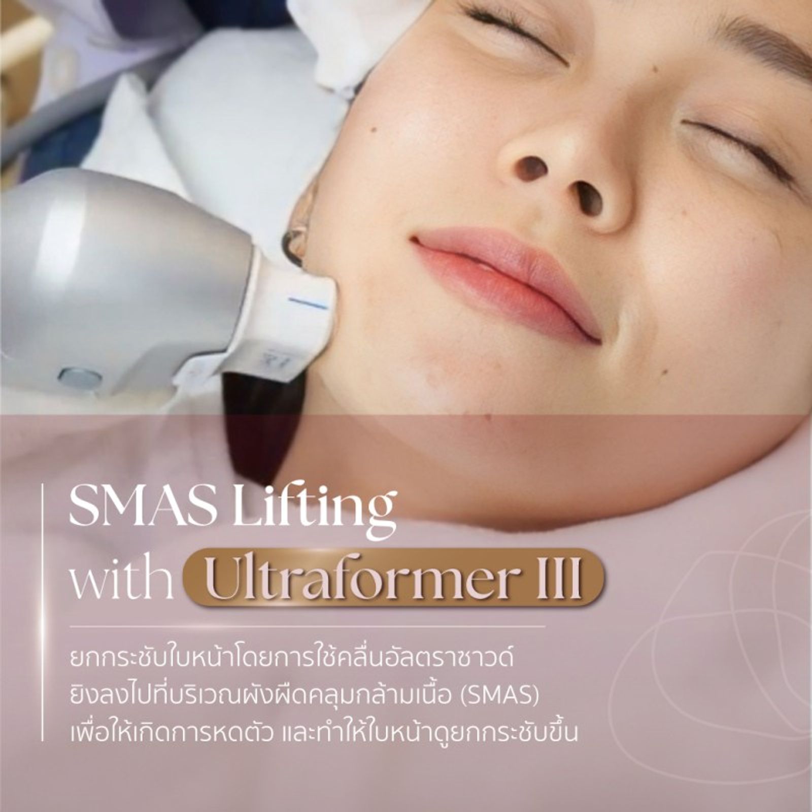 Facial Reshaping Non-Surgical Treatment การปรับรูปหน้าโดยไม่ต้องผ่าตัด — ภาพประกอบ 02