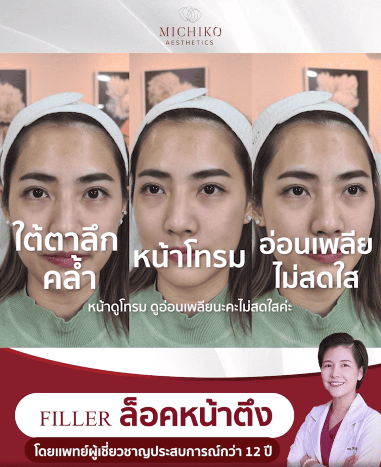 [รีวิว] ฉีดฟิลเลอร์ครั้งแรก!! แก้ไขใต้ตาลึก คล้ำ ให้ดูสดใส โดย คุณหมอกิ๊ฟ