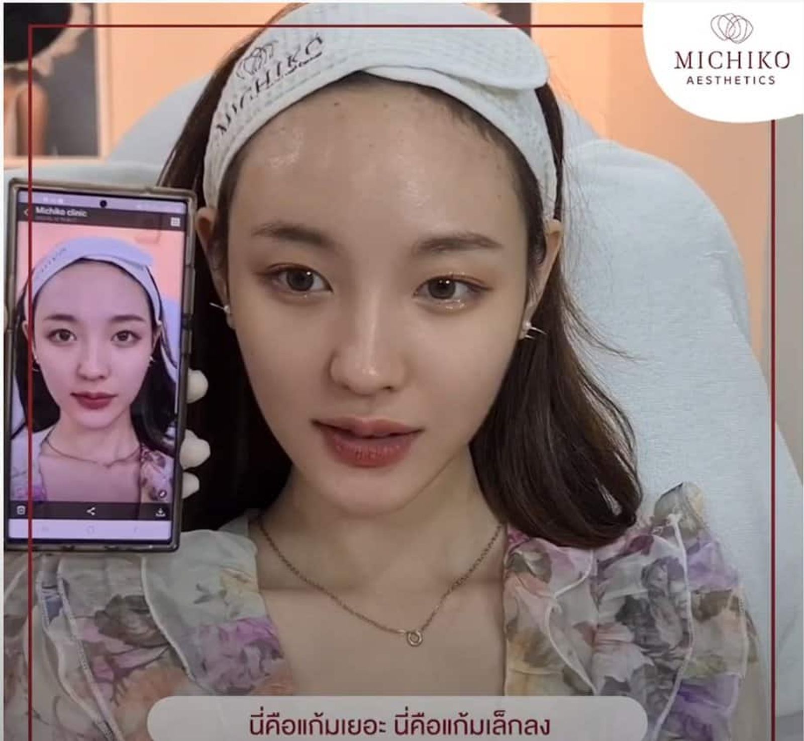 [รีวิว] โปรแกรม #ABOLifting 150 s.u. ที่คุณหมอดีไซน์ให้ทั้งการเก็บกรอบหน้า และลดริ้วรอย บางจุดบนใบหน้า