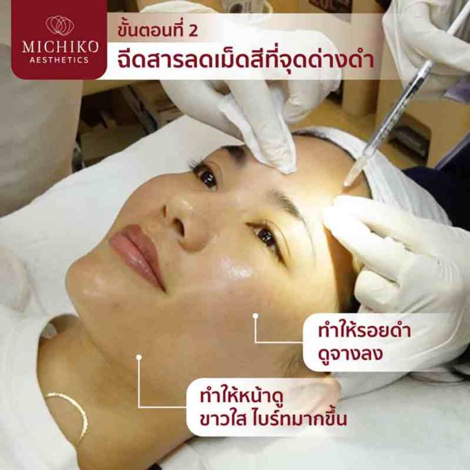 เมโสหน้าใส