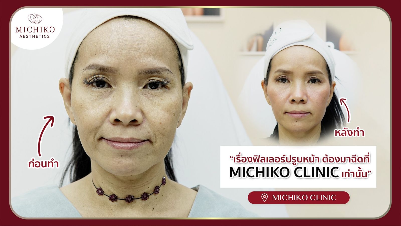 [รีวิว] จะเด็กลงแค่ไหน ? เมื่อมาทำฟิลเลอร์ใต้ตาที่ MICHIKO clinic