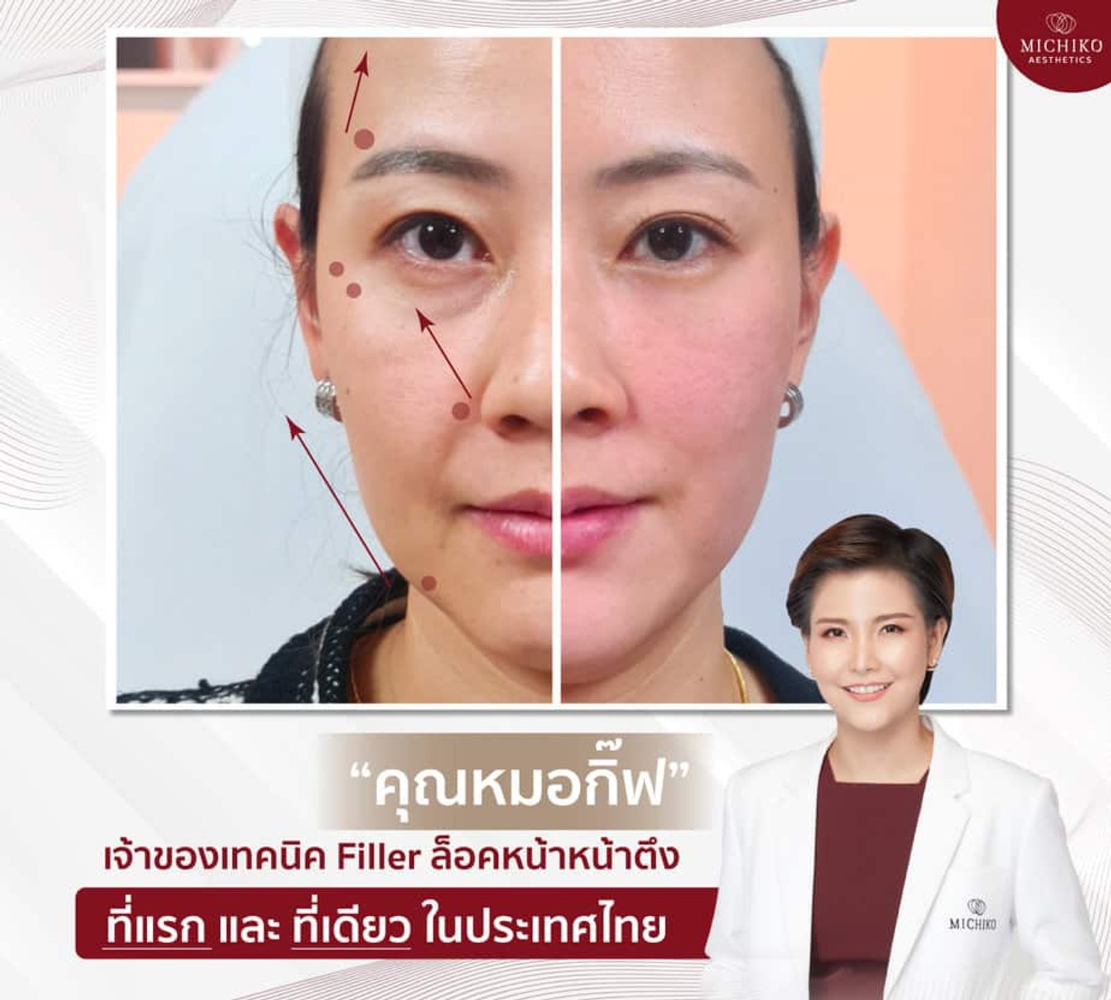 เทคนิค #ฟิลเลอร์ล็อคหน้าตึง คือการฉีดฟิลเลอร์แก้ไขโครงสร้าง ทำให้หน้ายกขึ้น อย่างเป็นธรรมชาติ — ภาพประกอบ 02