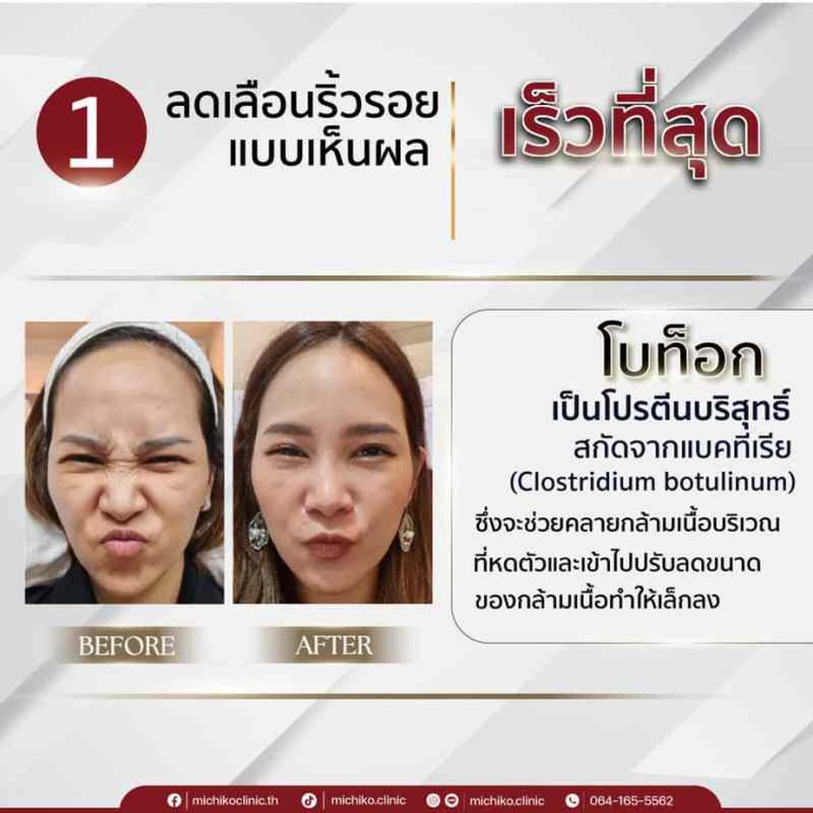 ลดริ้วรอย โบท็อก