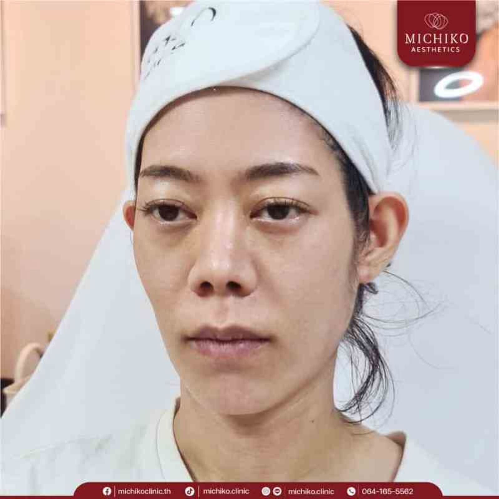 [รีวิว] หน้าตอบ ใต้ตาลึก ดูโทรม ฉีดฟิลเลอร์ใต้ตาที่มิชิโกะคลินิก ทำให้มั่นใจขึ้นเป็นกอง — ภาพประกอบ 03