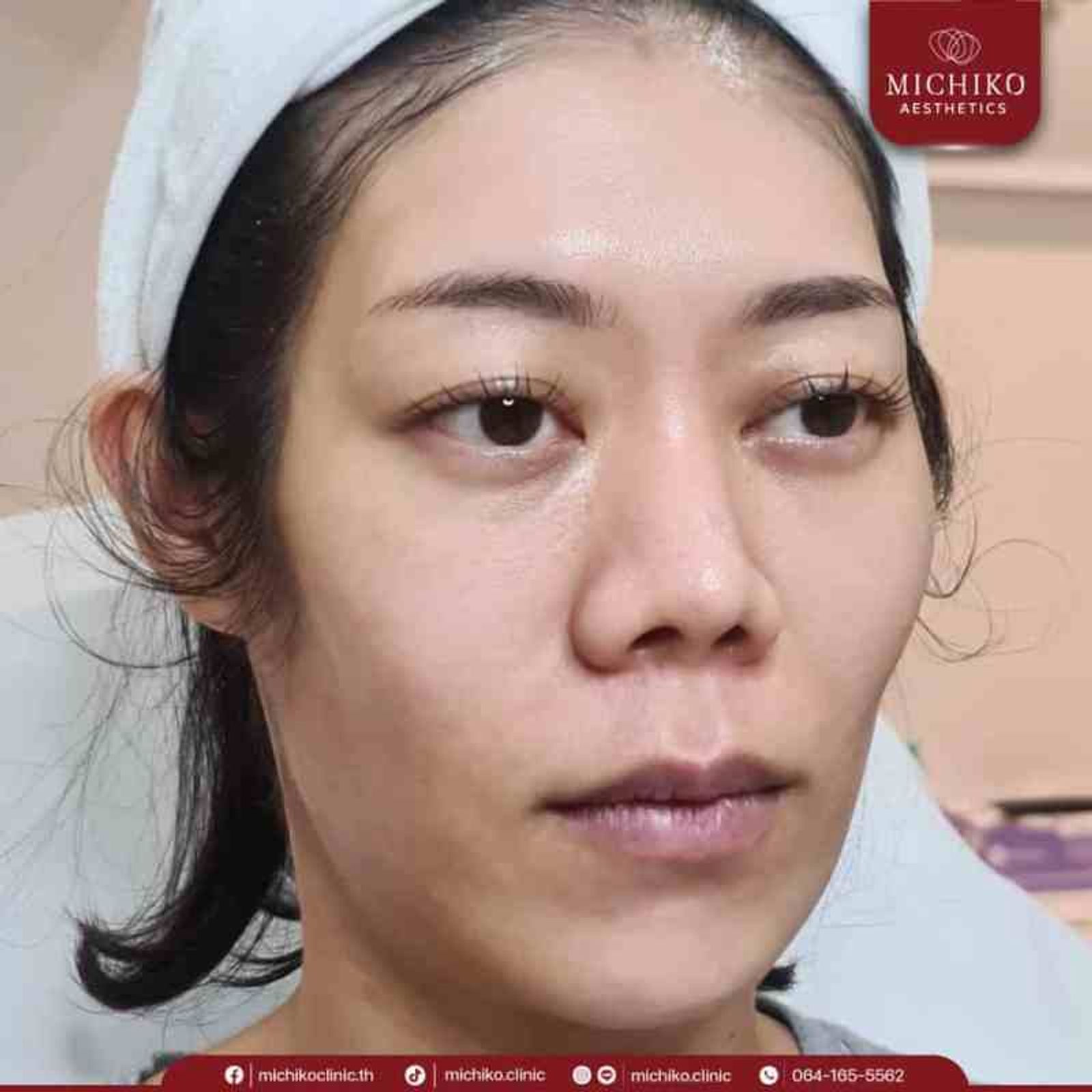 [รีวิว] หน้าตอบ ใต้ตาลึก ดูโทรม ฉีดฟิลเลอร์ใต้ตาที่มิชิโกะคลินิก ทำให้มั่นใจขึ้นเป็นกอง — ภาพประกอบ 02
