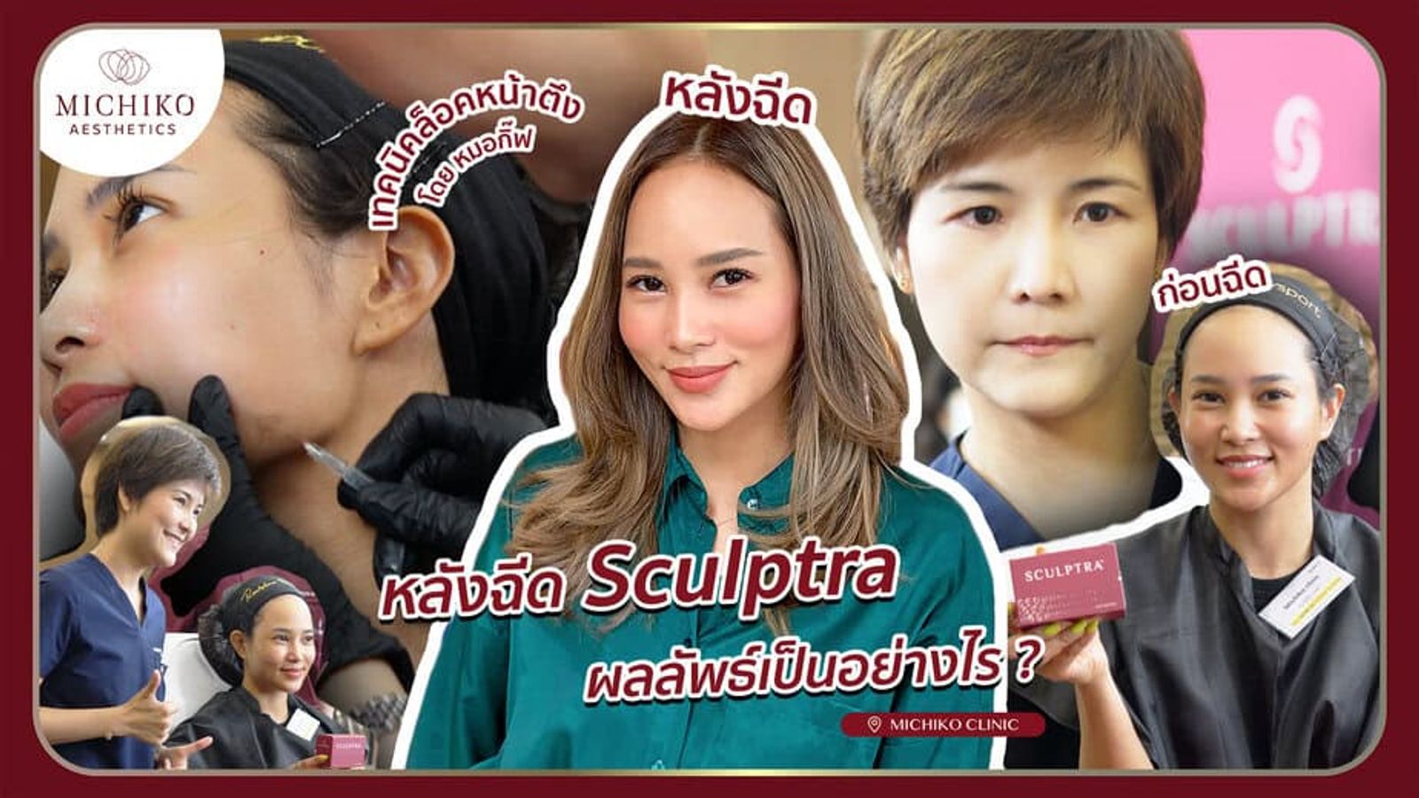 [รีวิว] ผลลัพธ์หลังฉีด Sculptra เพิ่มคอลลาเจนให้ผิวหน้าที่หย่อนคล้อย ที่มิชิโกะคลินิก
