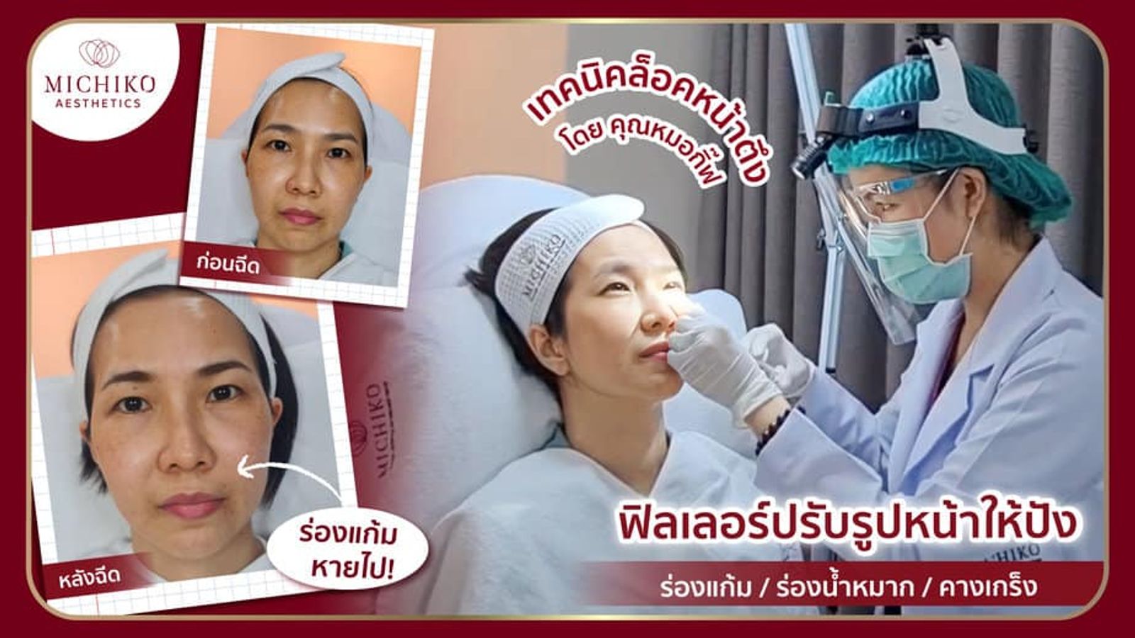 [รีวิว] ร่องแก้ม ร่องน้ำหมาก และคางเกร็ง จะหมดไปด้วยการฉีดฟิลเลอร์ล็อคหน้าตึง