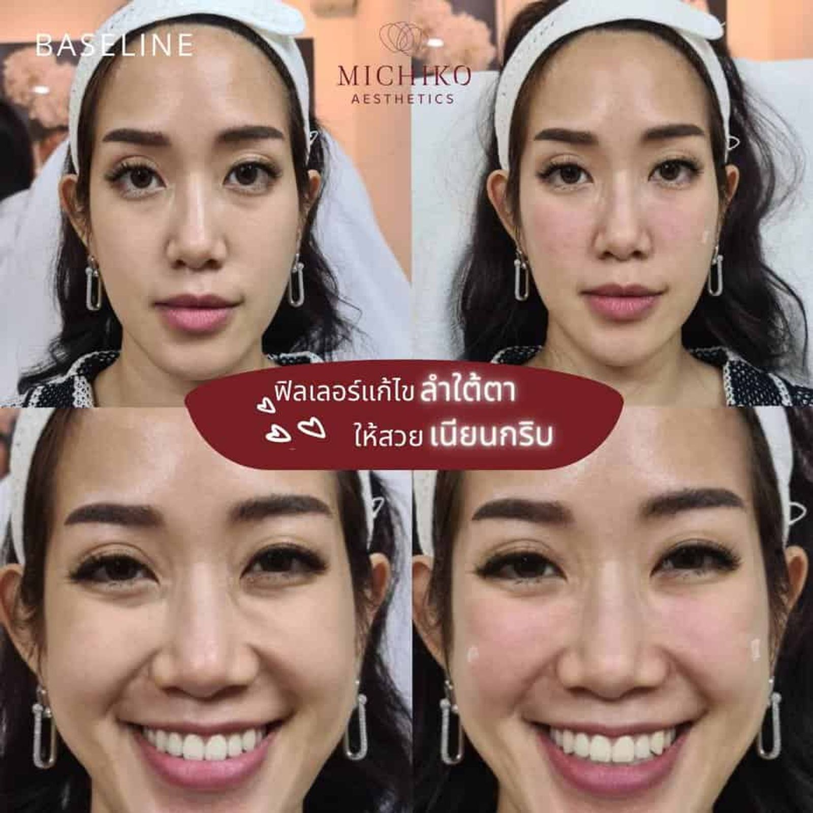 [รีวิว] #การแก้ไขลำกล้ามเนื้อใต้ตา ด้วยการฉีดฟิลเลอร์ปรับแก้ไขโครงสร้าง และควบคุมการทำงานของกล้ามเนื้อยิ้ม ให้ดูเนียนสวย