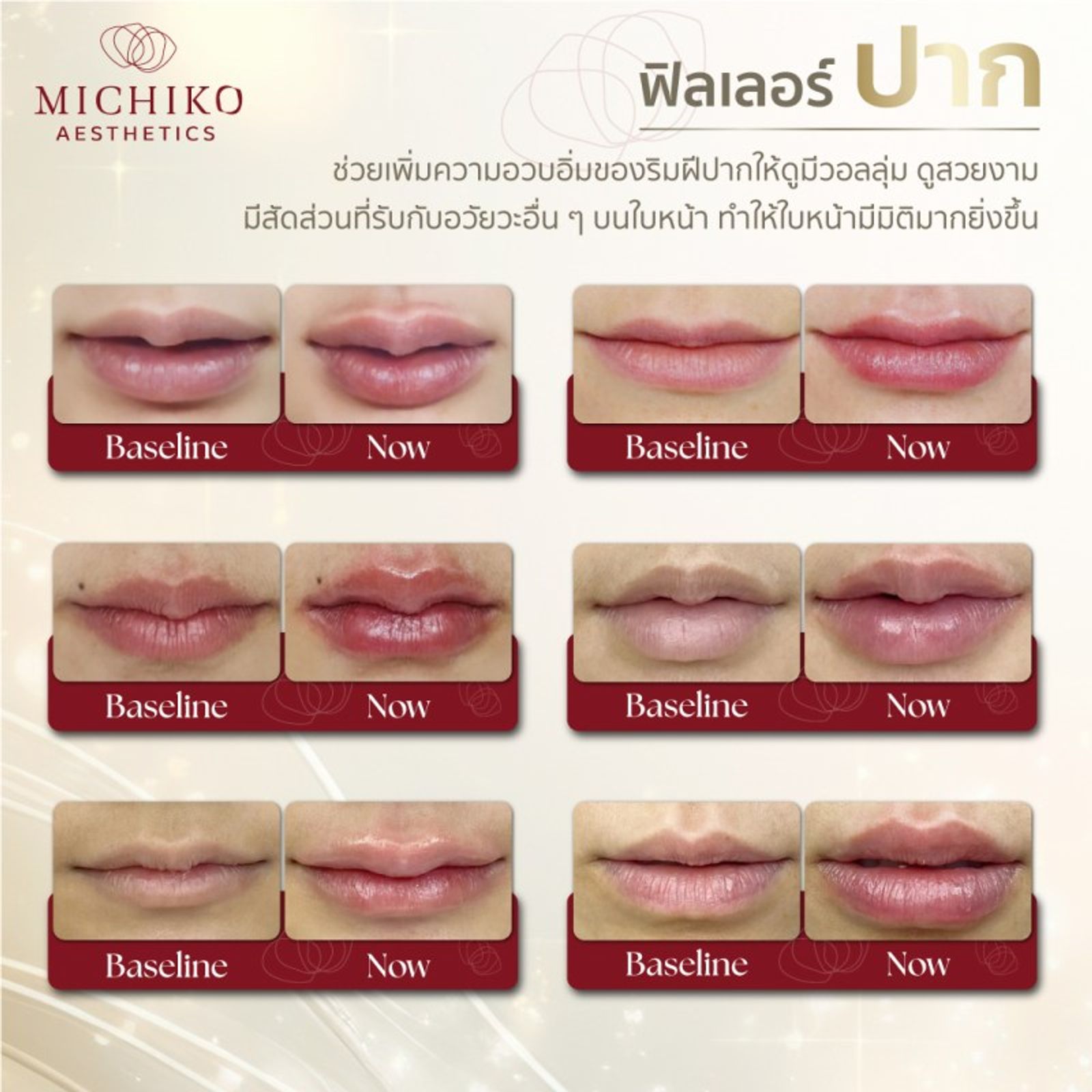 จุดฉีดฟิลเลอร์แล้วสวยแน่นอน !!! — ภาพประกอบ 01