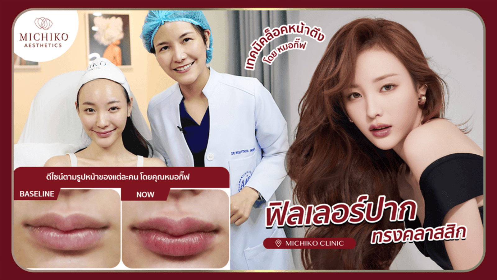[รีวิว] แค่ฉีดฟิลเลอร์ปาก 1 CC ก็ได้ปากที่สวยเหมือนสาวเกาหลีเลยค่าาา