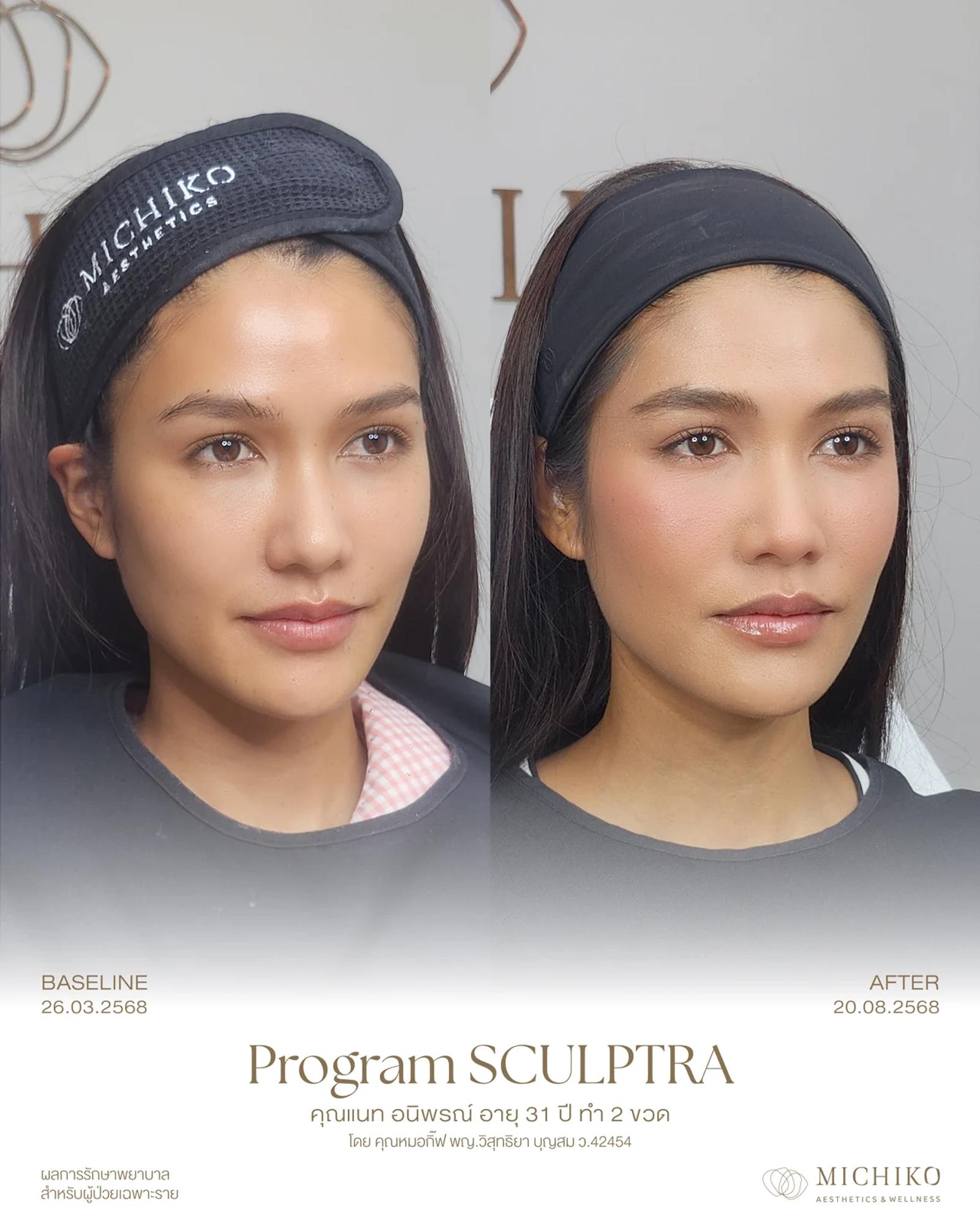 ต่างคน ต่างแผนการดูแล — ภาพเคส Sculptra ของ MICHIKO ผลลัพธ์เฉพาะบุคคล