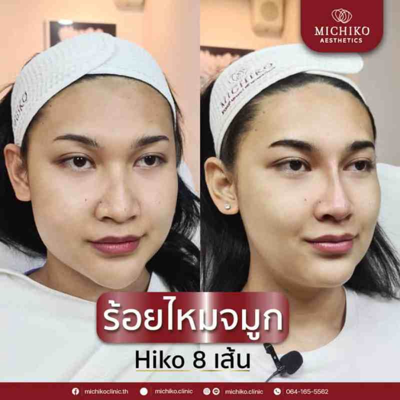 ร้อยไหมจมูกเหมาะกับใครบ้าง !!?? — ภาพประกอบ 02
