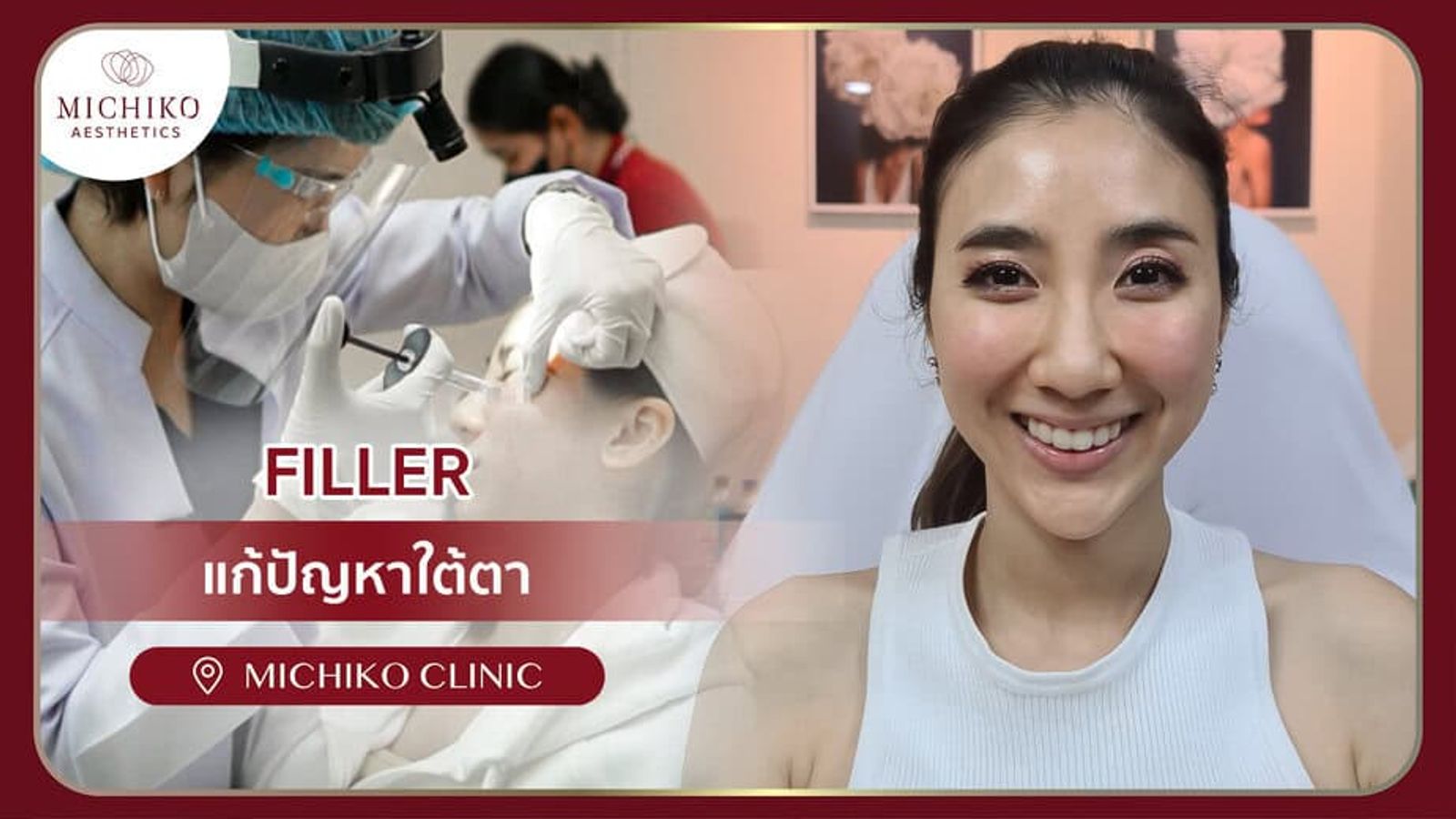[รีวิว] ยิ้มแล้วเป็นก้อนใต้ตาและหน้าดูบวม แก้ไขฟิลเลอร์กับคุณหมอกิ๊ฟที่มิชิโกะคลินิก
