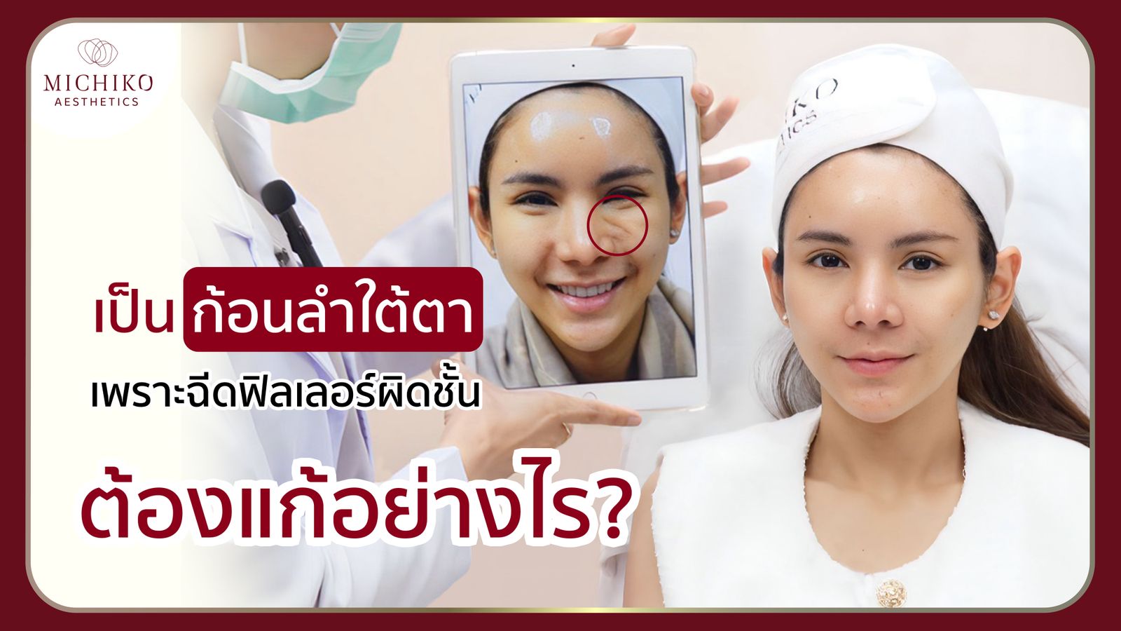 [รีวิว] ก้อนลำใต้ตาใหญ่มากกกก แก้ด้วยฟิลเลอร์ได้ไหม !???