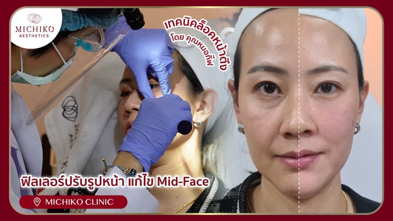 [รีวิว] หน้าเด็กลงเพราะฉีดฟิลเลอร์ด้วยเทคนิคล็อคหน้าตึง โดย คุณหมอกิ๊ฟ