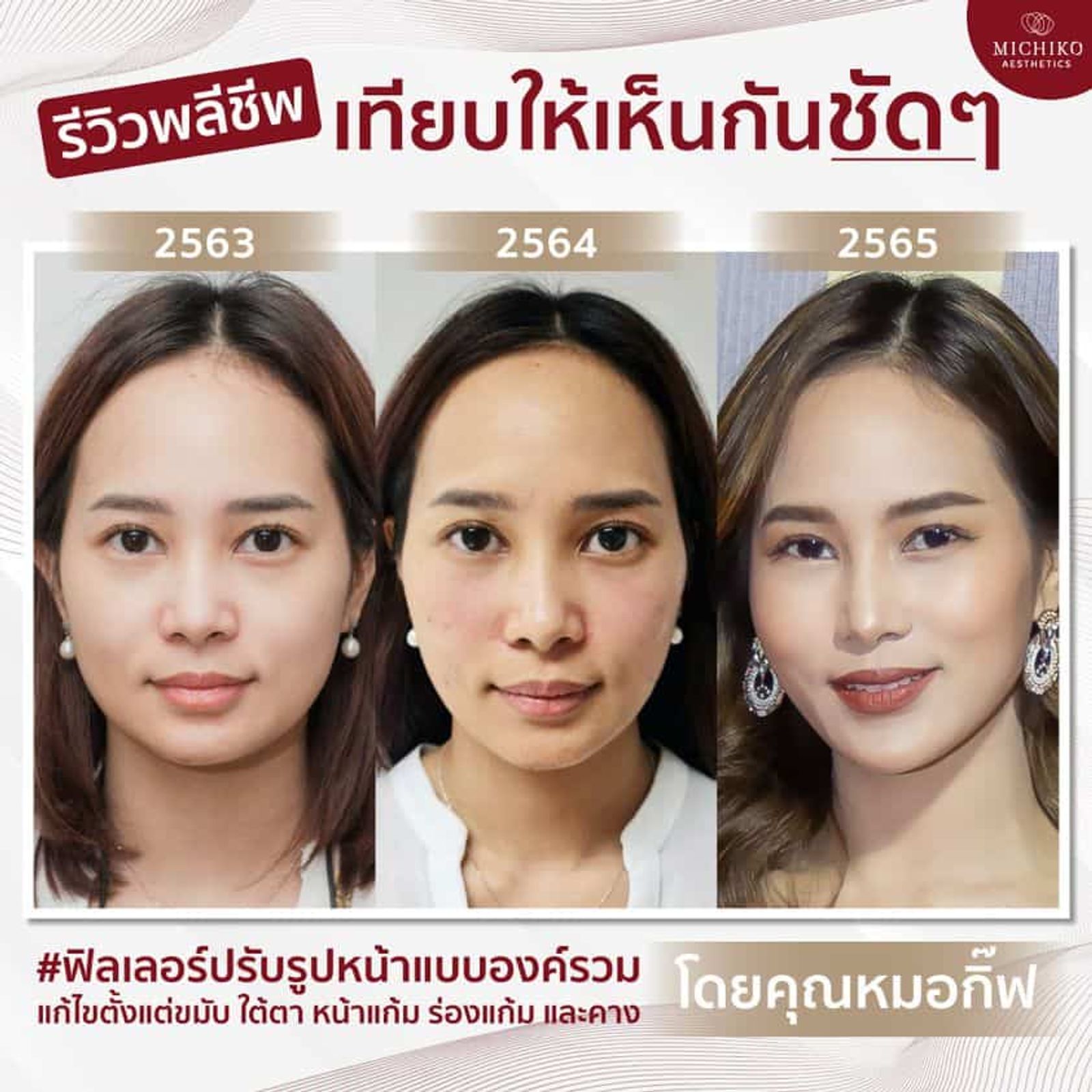 [รีวิว] ฟิลเลอร์ล็อคหน้า #ดีไซน์เฉพาะบุคคล คุณกิ่งสวยขึ้นจนงงว่านี่คนเดียวกันไหม