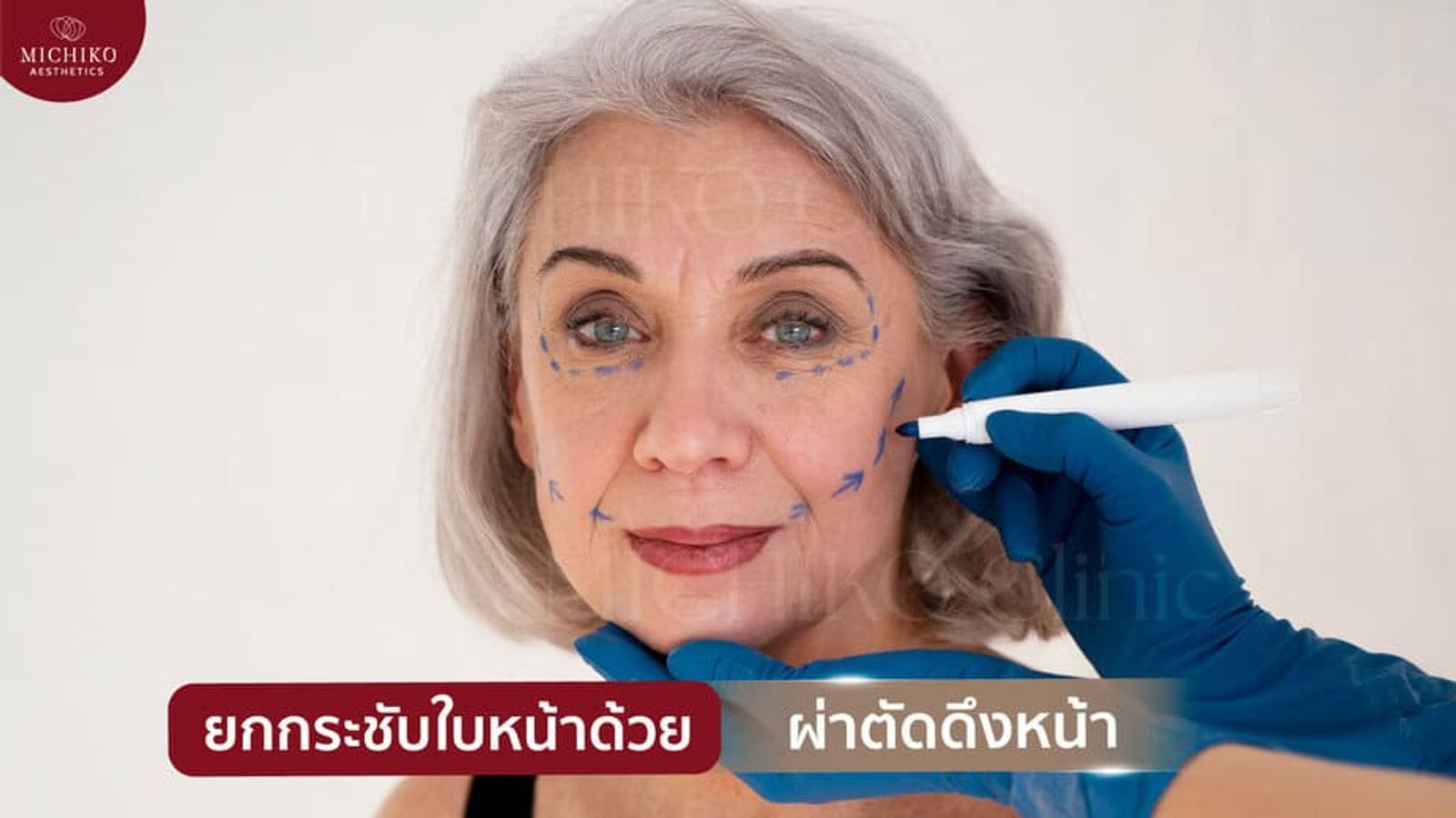 ผ่าตัดดึงหน้า คืออะไร