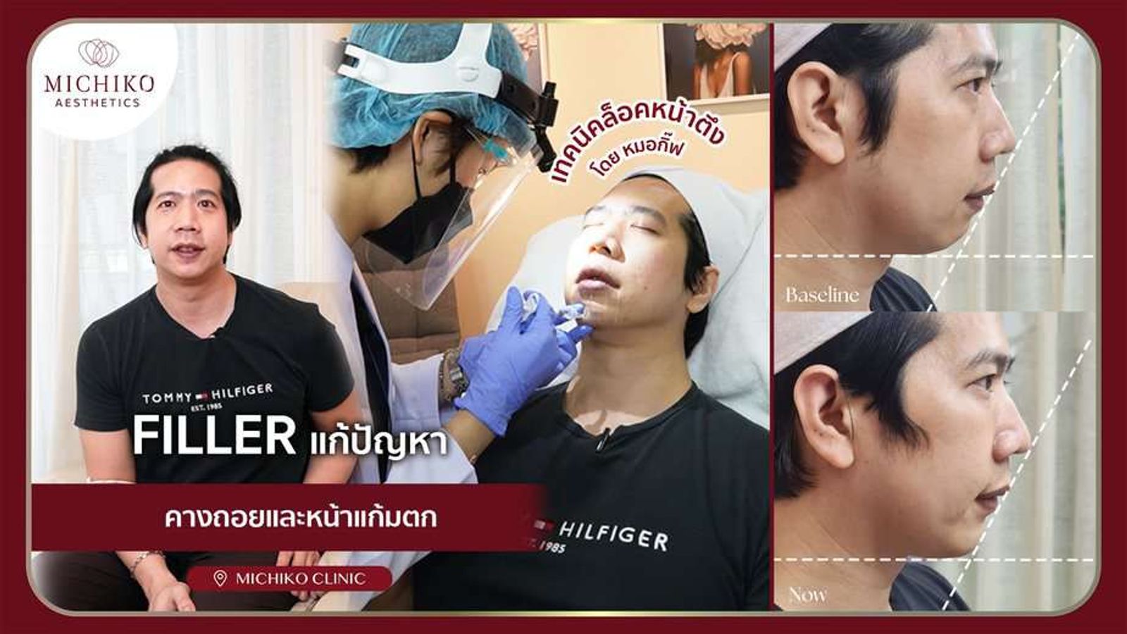 [รีวิว] ปรับรูปหน้า แก้คางถอย หน้าแก้มตกด้วยการฉีดฟิลเลอร์
