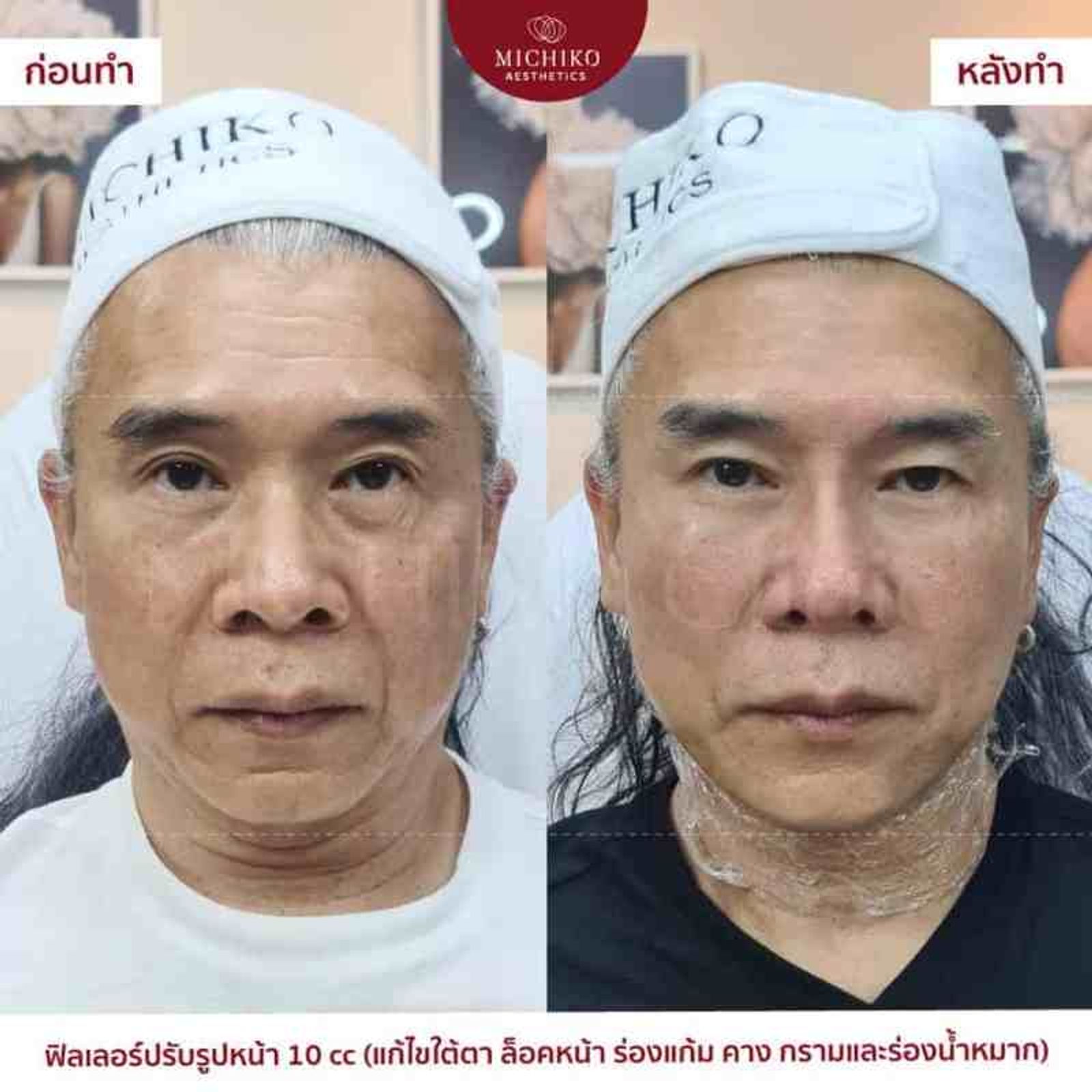 หน้าหย่อนคล้อย ไม่กระชับ เลือกทำหัตถการไหนดี? — ภาพประกอบ 07