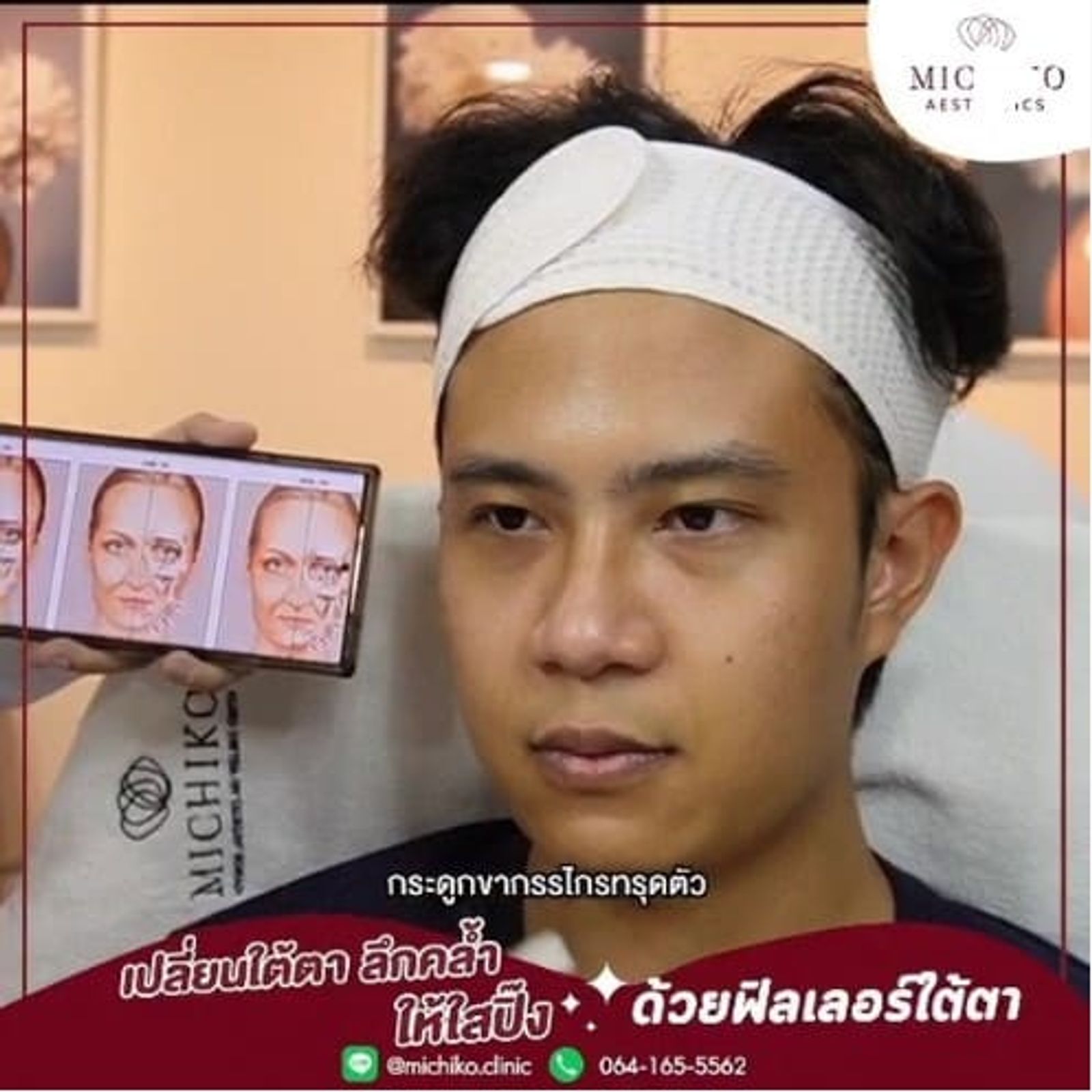 [รีวิว] ใต้ตาดูสดใสได้ไม่ต้องง้ออายครีม ด้วยโปรแกรมฟิลเลอร์ โดยคุณหมอกิ๊ฟ