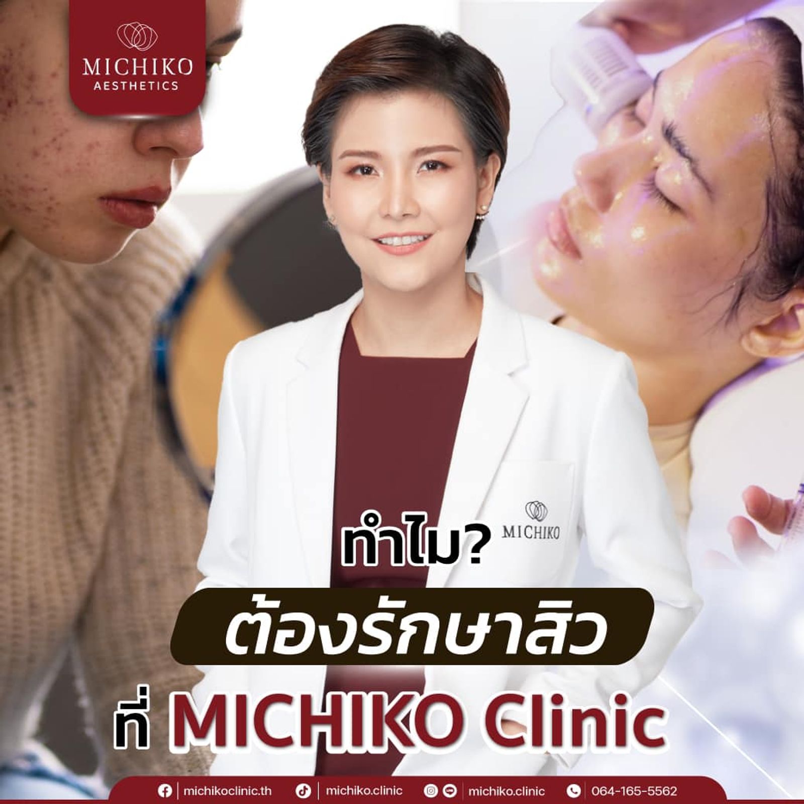 How to รักษาสิว ที่ Michiko clinic