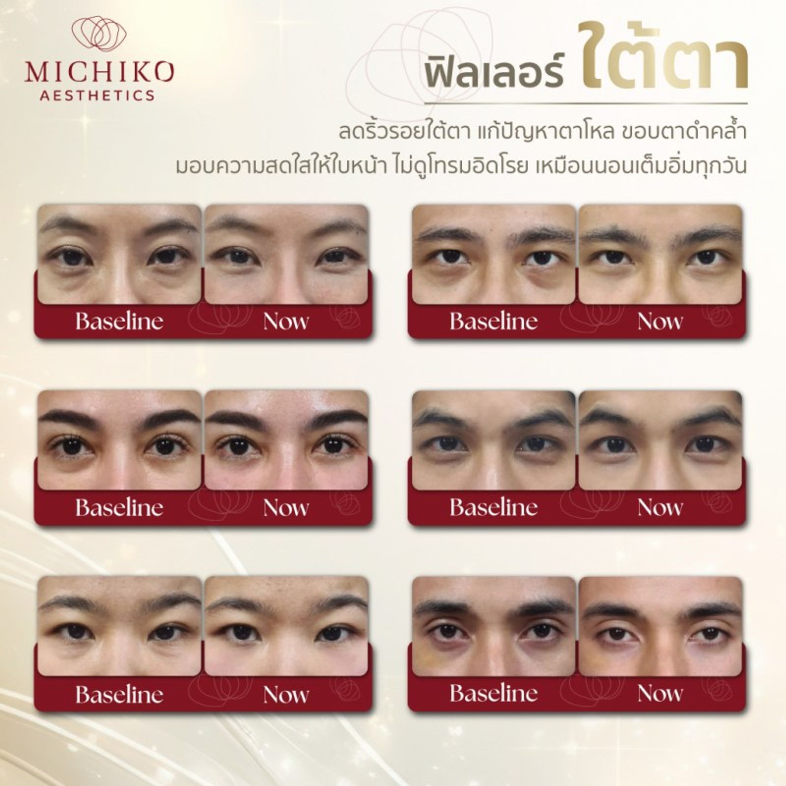 จุดฉีดฟิลเลอร์แล้วสวยแน่นอน !!! — ภาพประกอบ 03