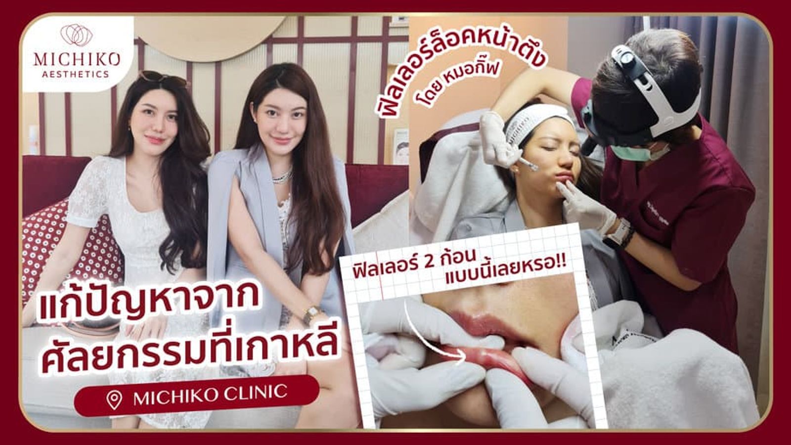 [รีวิว] ปังมาก! ฉีดฟิลเลอร์ล็อคหน้าตึงที่ Michiko Clinic แก้ปัญหาหลังจากทำศัลยกรรมจากเกาหลี
