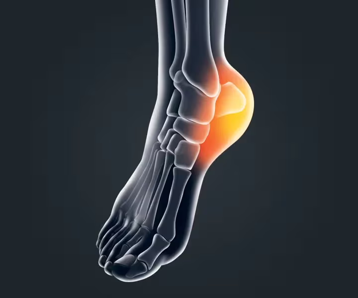 Cover image for blog post: Heel Pain: Causes, Symptoms & Physiotherapy Treatment