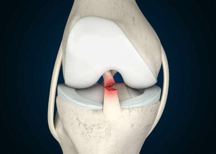 Cover image for blog post: ACL Tear: Surgery vs Conservative Treatment — What’s Best for You?
