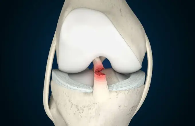 Cover image for blog post: ACL Tear: Surgery vs Conservative Treatment — What’s Best for You?