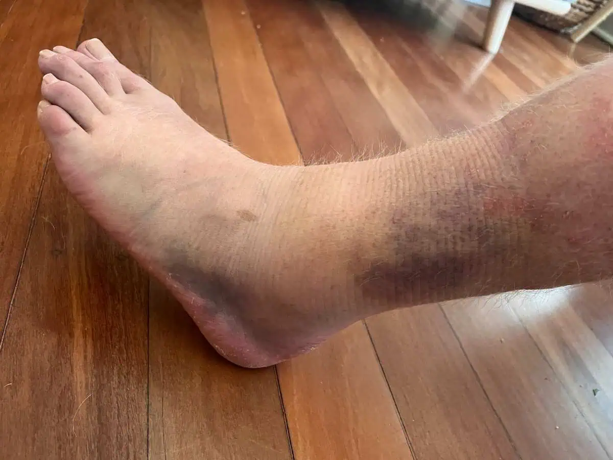 Cover image for blog post: Can Physiotherapy Help with Recurrent Ankle Sprains?