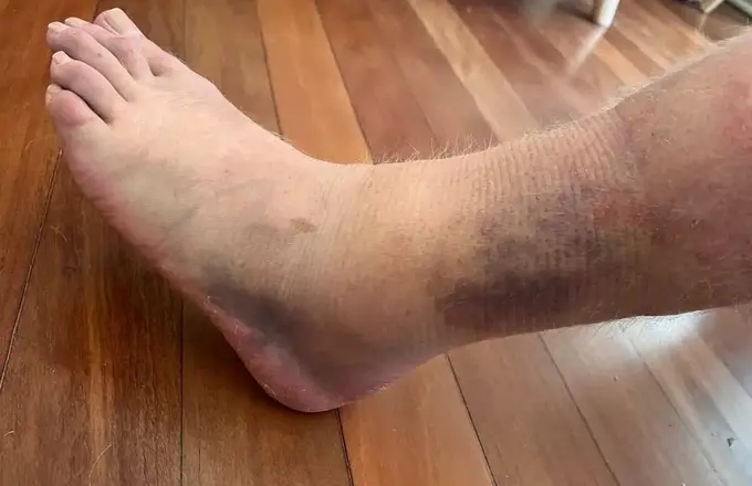 Cover image for blog post: Can Physiotherapy Help with Recurrent Ankle Sprains?