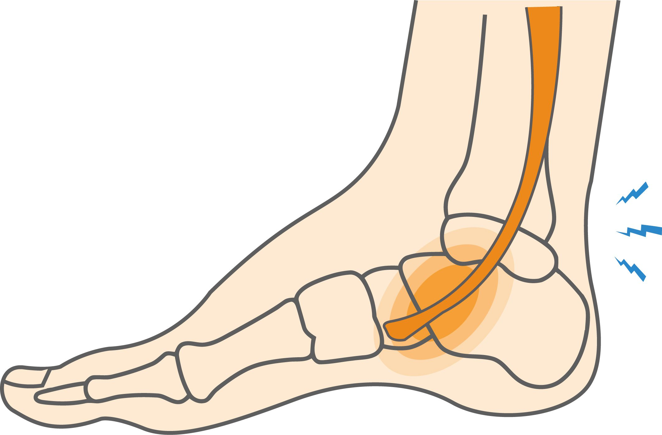 Cover image for blog post: Posterior Tibialis Tendon Tendinopathy: Causes, Symptoms & Physiotherapy Treatment